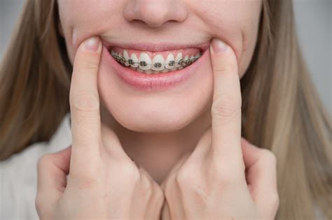 What You Need to Know About Metal Braces